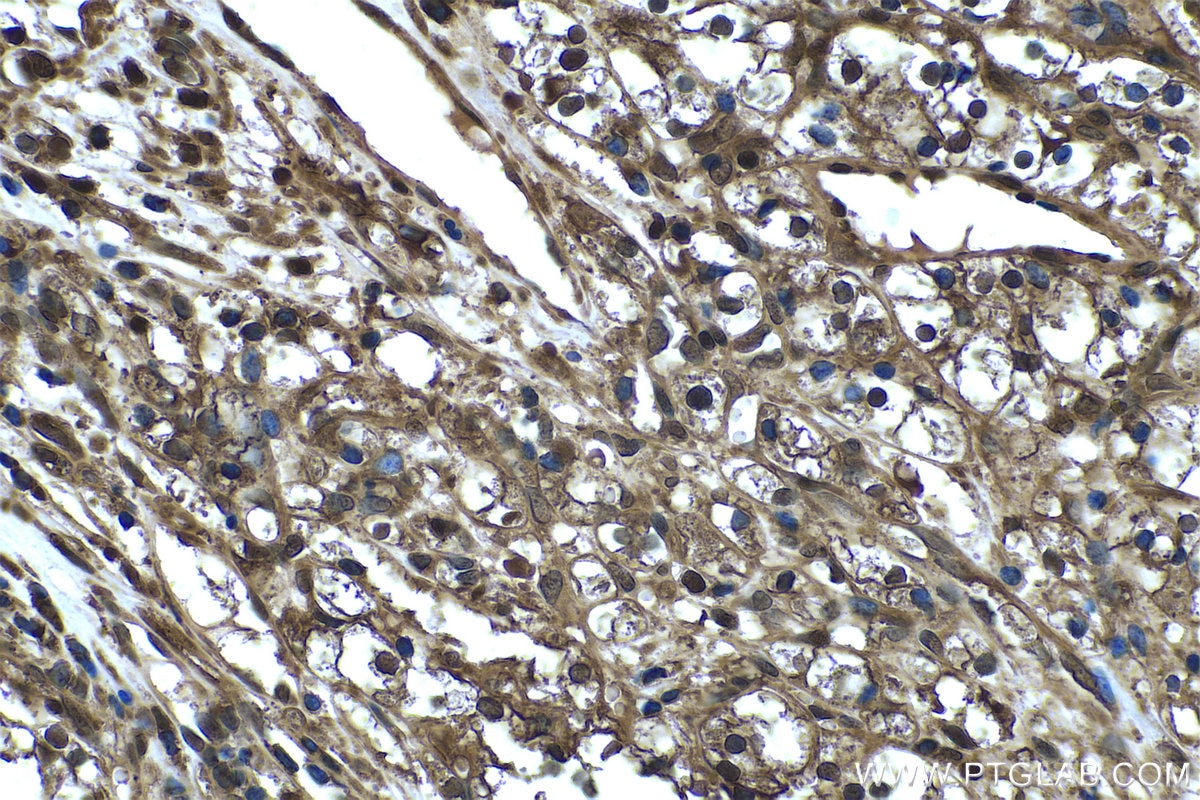 Immunohistochemical analysis of paraffin-embedded human renal cell carcinoma tissue slide using KHC0449 (PSME2 IHC Kit).