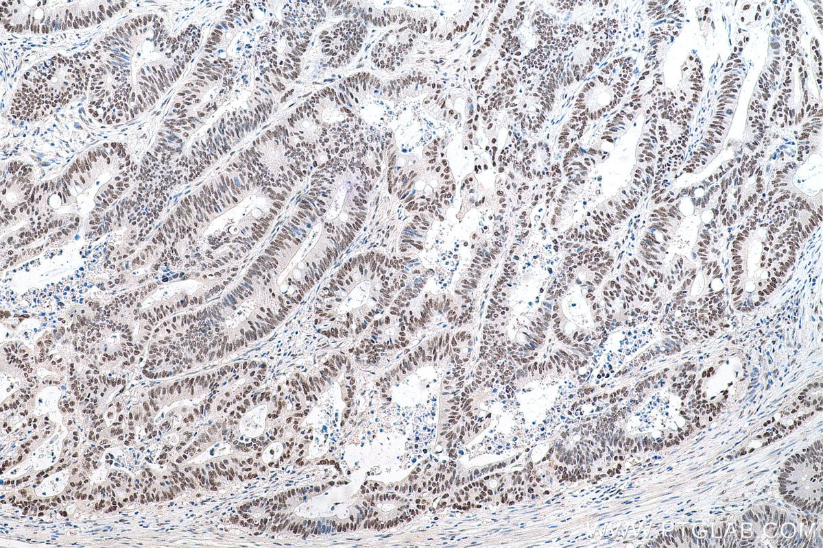Immunohistochemical analysis of paraffin-embedded human colon cancer tissue slide using KHC0764 (PSME3 IHC Kit).