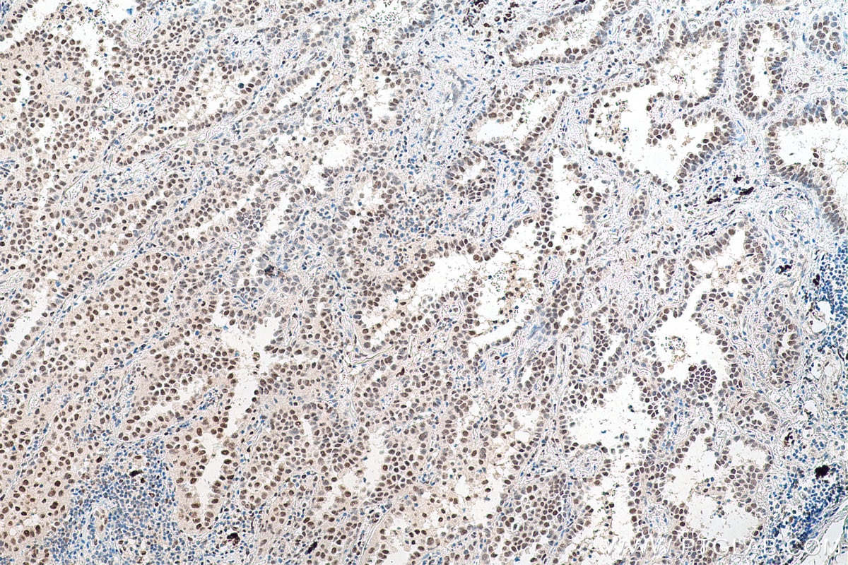 Immunohistochemical analysis of paraffin-embedded human lung cancer tissue slide using KHC0764 (PSME3 IHC Kit).