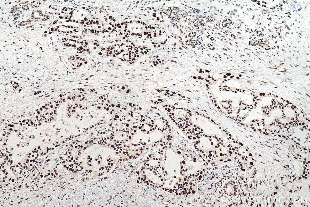 Immunohistochemical analysis of paraffin-embedded human pancreas cancer tissue slide using KHC0764 (PSME3 IHC Kit).