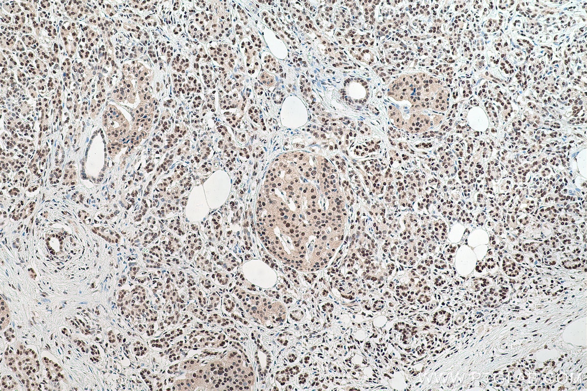 Immunohistochemical analysis of paraffin-embedded human pancreas cancer tissue slide using KHC0764 (PSME3 IHC Kit).