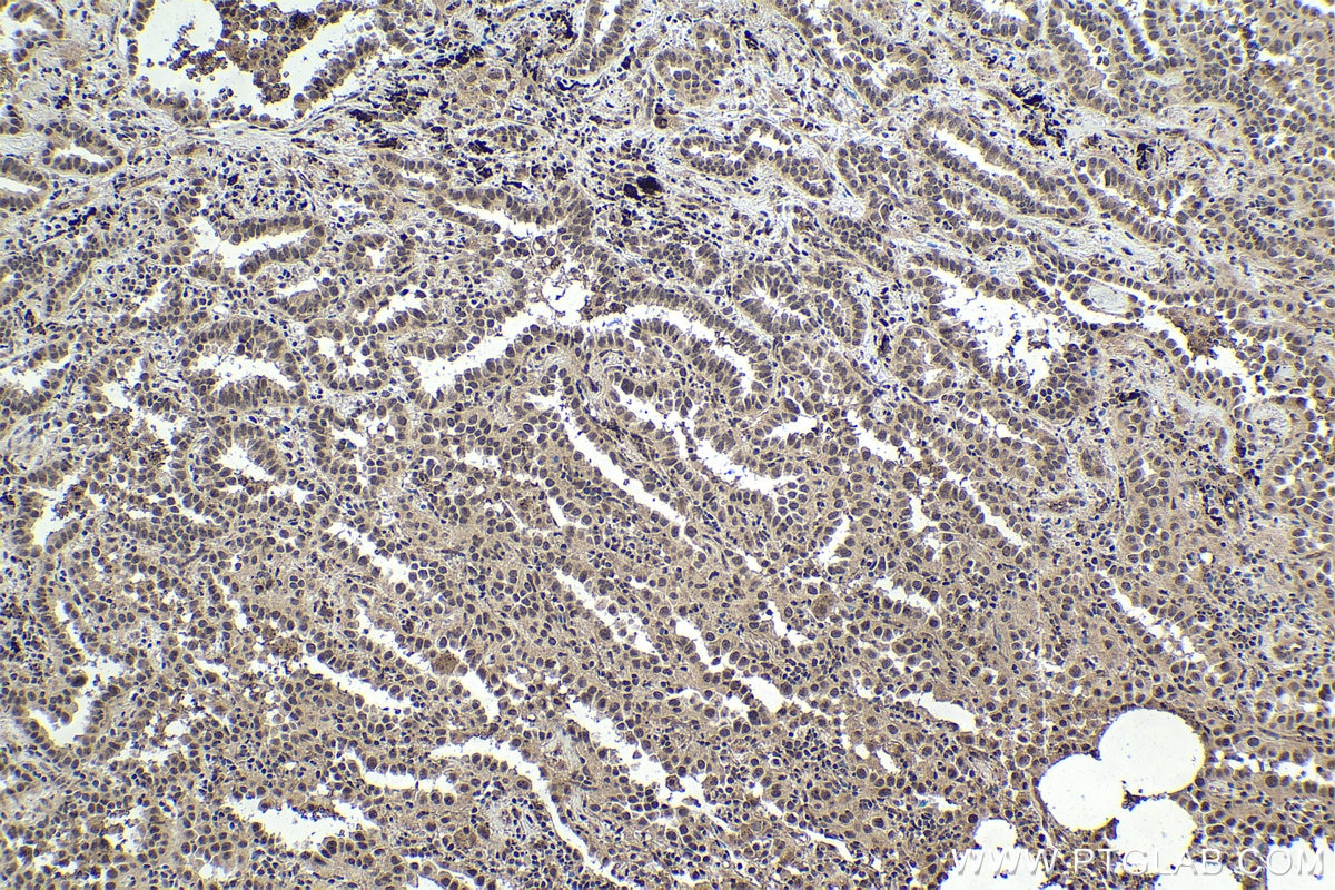 Immunohistochemical analysis of paraffin-embedded human lung cancer tissue slide using KHC1745 (PSME4 IHC Kit).