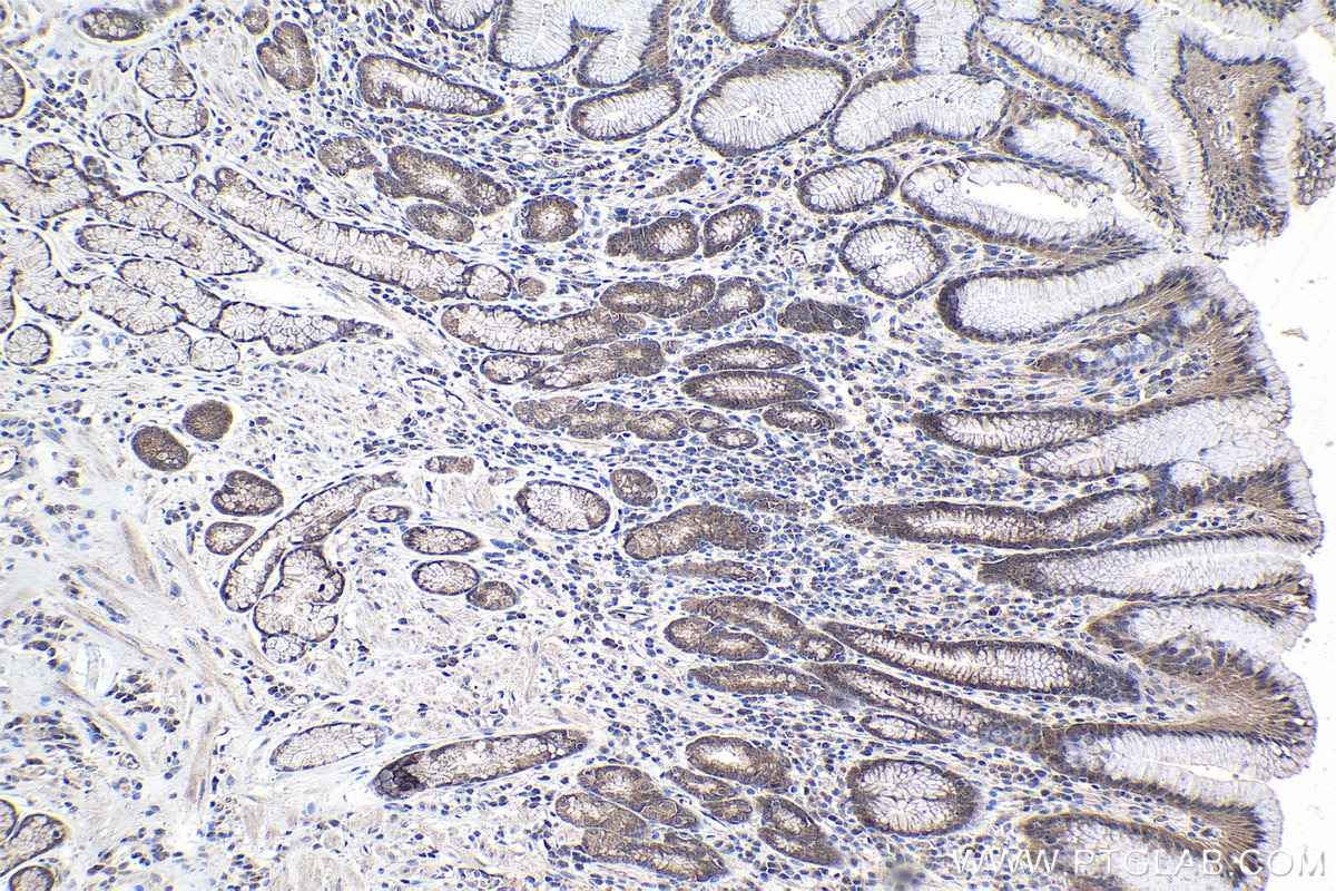Immunohistochemical analysis of paraffin-embedded human stomach cancer tissue slide using KHC1033 (PSMG1 IHC Kit).