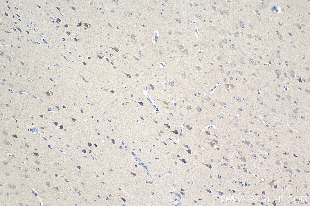 Immunohistochemical analysis of paraffin-embedded human gliomas tissue slide using KHC1033 (PSMG1) at dilution of 1:500 (under 10x lens). Heat mediated antigen retrieval with Tris-EDTA buffer (pH 9.0).