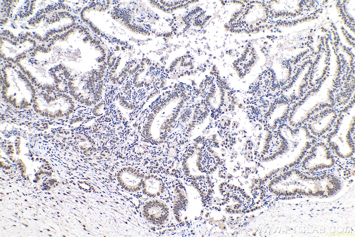 Immunohistochemical analysis of paraffin-embedded human ovary tumor tissue slide using KHC0667 (PTBP1 IHC Kit).
