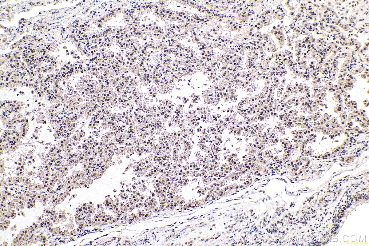 Immunohistochemical analysis of paraffin-embedded human lung cancer tissue slide using KHC0667 (PTBP1 IHC Kit).