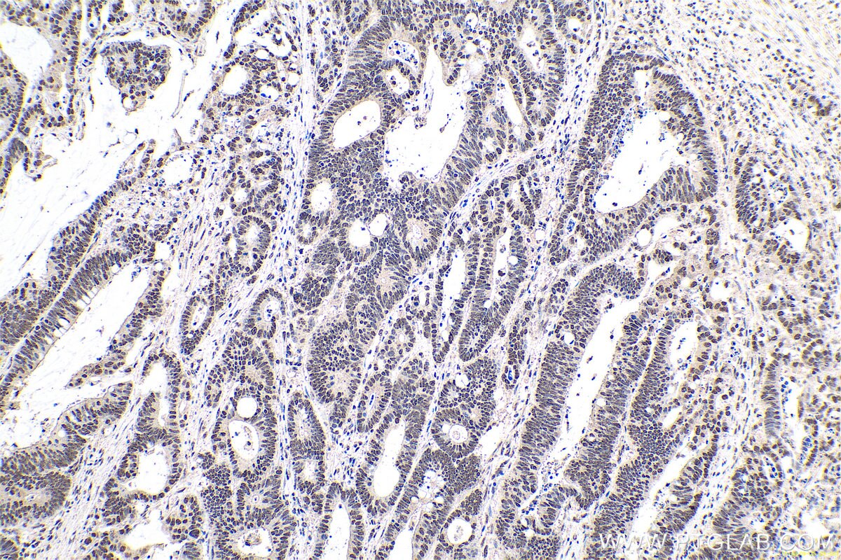 Immunohistochemical analysis of paraffin-embedded human colon cancer tissue slide using KHC0667 (PTBP1 IHC Kit).