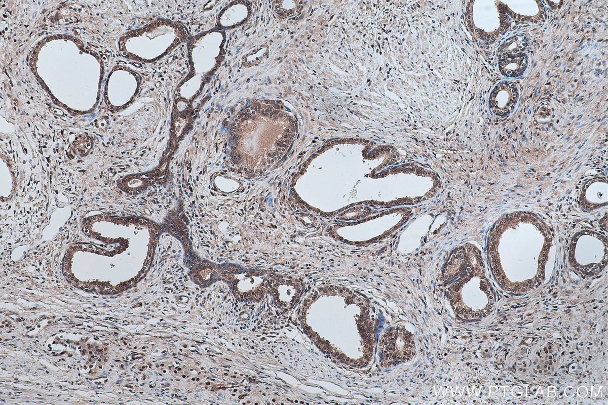 Immunohistochemical analysis of paraffin-embedded human prostate cancer tissue slide using KHC0280 (PTEN IHC Kit).