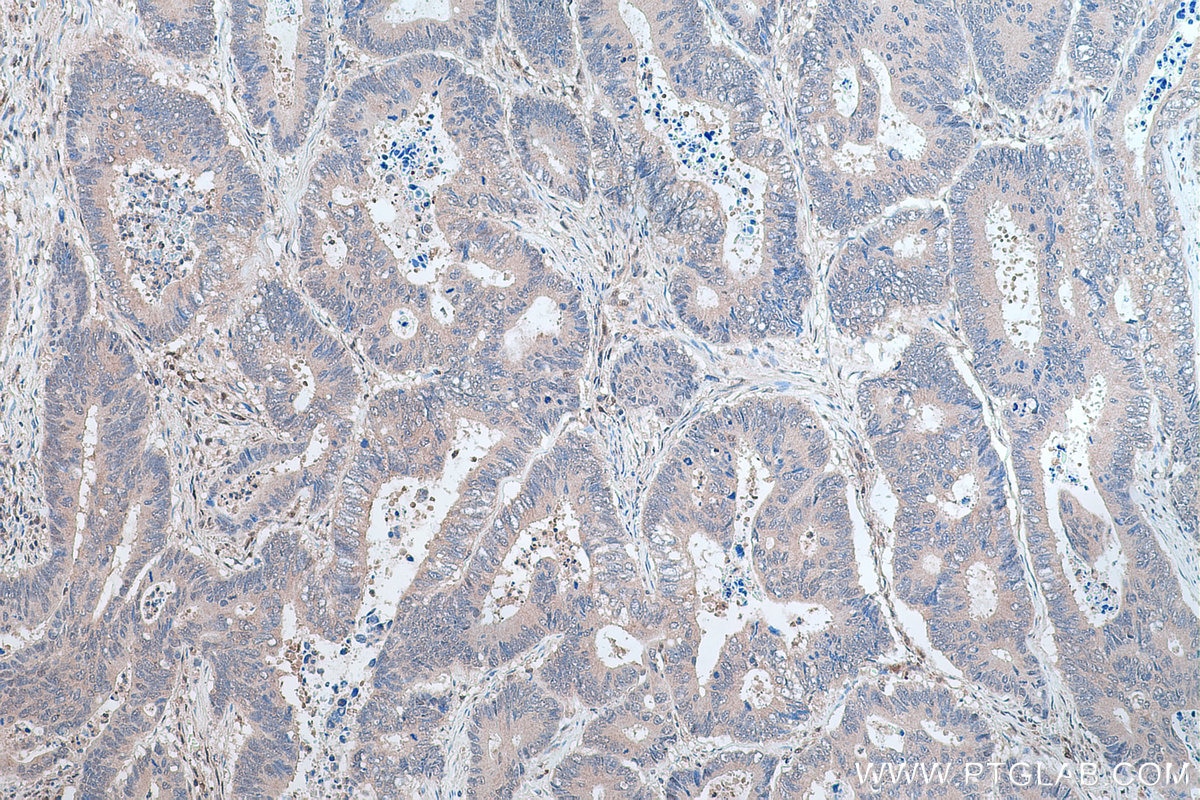 Immunohistochemical analysis of paraffin-embedded human colon cancer tissue slide using KHC0280 (PTEN IHC Kit).