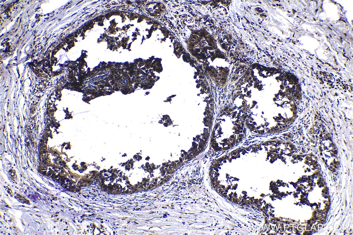 Immunohistochemical analysis of paraffin-embedded human breast cancer tissue slide using KHC1186 (PTGES3 IHC Kit).