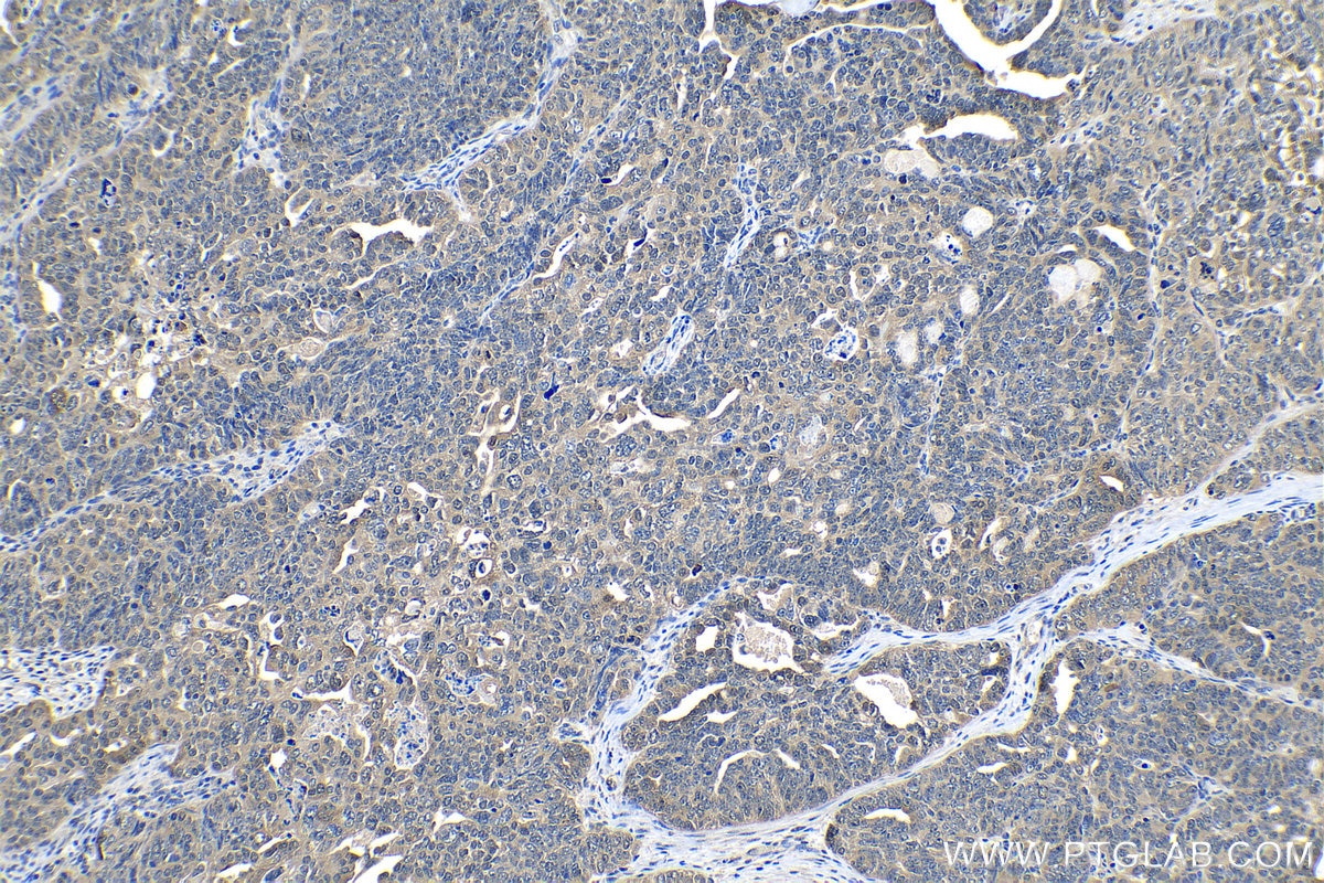 Immunohistochemical analysis of paraffin-embedded human ovary tumor tissue slide using KHC1186 (PTGES3 IHC Kit).