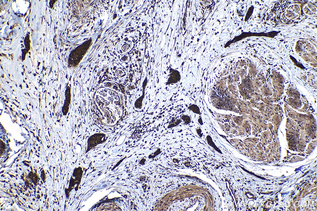Immunohistochemical analysis of paraffin-embedded human urothelial carcinoma tissue slide using KHC1186 (PTGES3 IHC Kit).