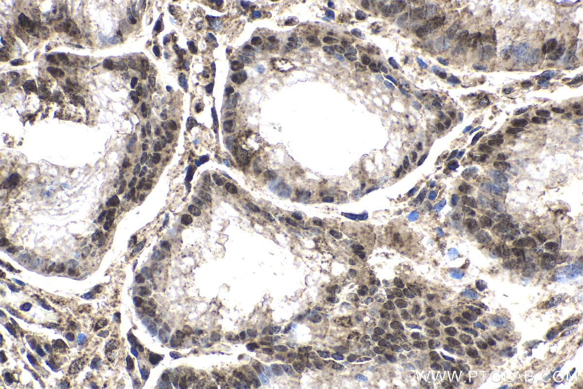 Immunohistochemical analysis of paraffin-embedded human stomach cancer tissue slide using KHC1721 (PTK6/BRK IHC Kit).