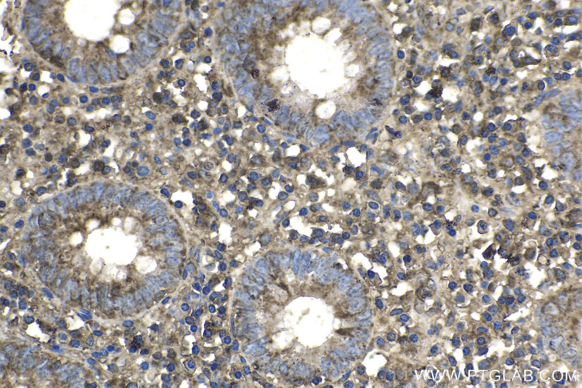 Immunohistochemical analysis of paraffin-embedded human appendicitis tissue slide using KHC1721 (PTK6/BRK IHC Kit).