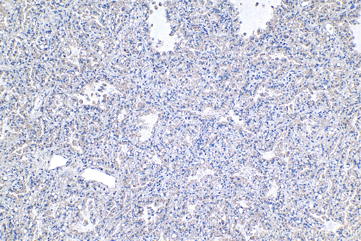 Immunohistochemical analysis of paraffin-embedded human lung cancer tissue slide using KHC1263 (PTP4A1 IHC Kit).