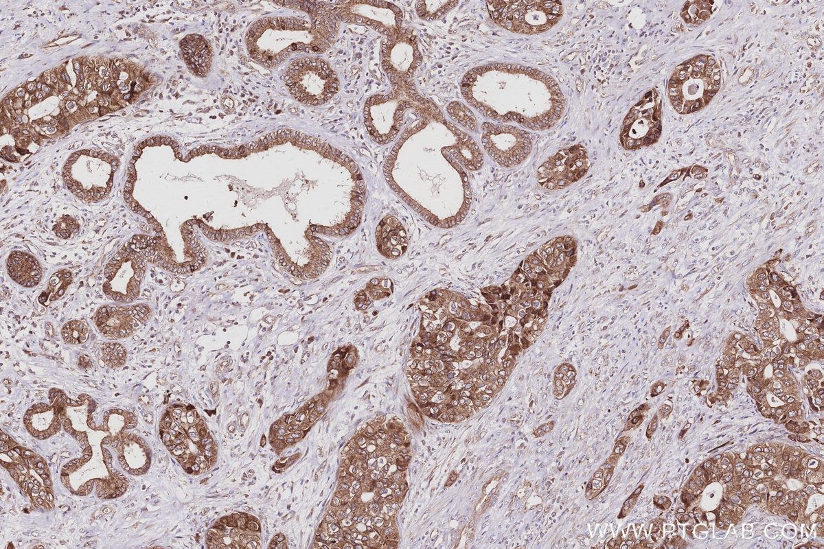Immunohistochemical analysis of paraffin-embedded human pancreas cancer tissue slide using KHC2983 (PTPLAD1 IHC Kit). Immunohistochemical analysis of paraffin-embedded human pancreas cancer tissue slide using KHC2983 (PTPLAD1 IHC Kit).