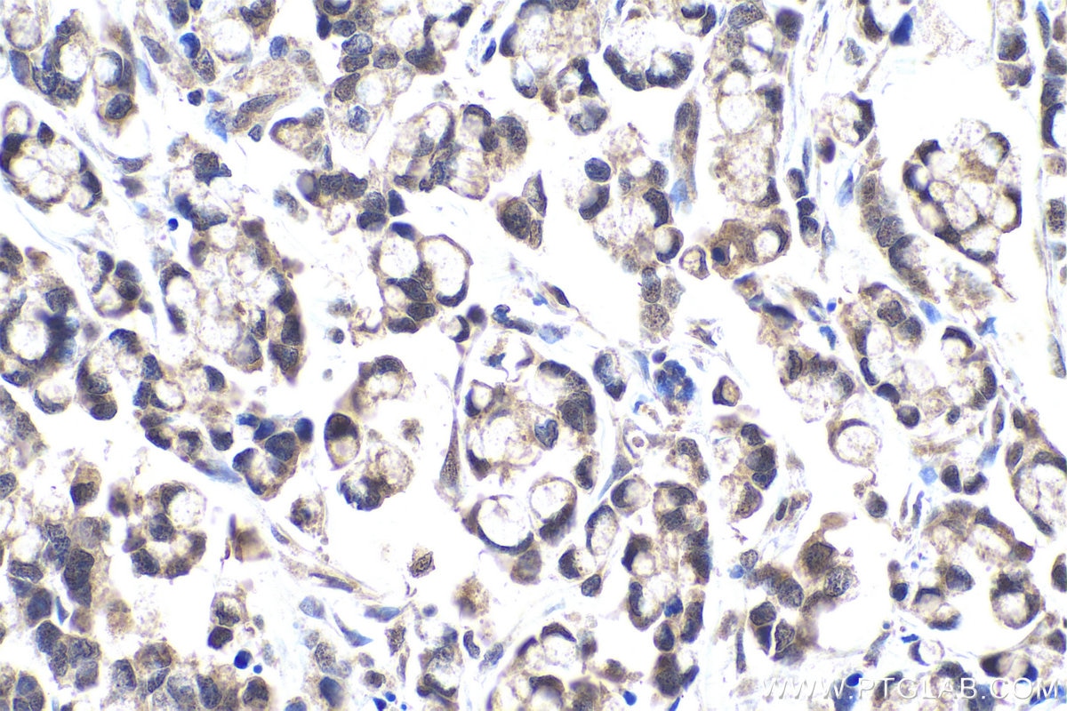 Immunohistochemical analysis of paraffin-embedded human colon cancer tissue slide using KHC0964 (PTPN11 IHC Kit).