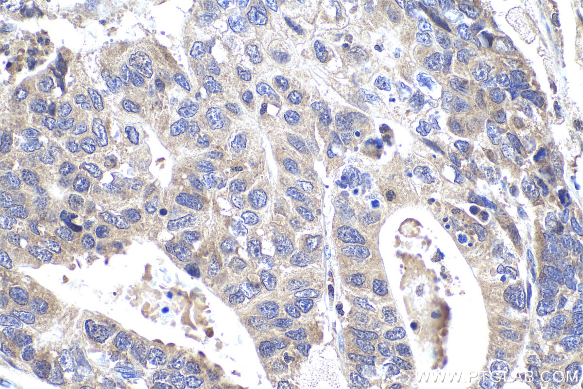 Immunohistochemical analysis of paraffin-embedded human stomach cancer tissue slide using KHC0964 (PTPN11 IHC Kit).