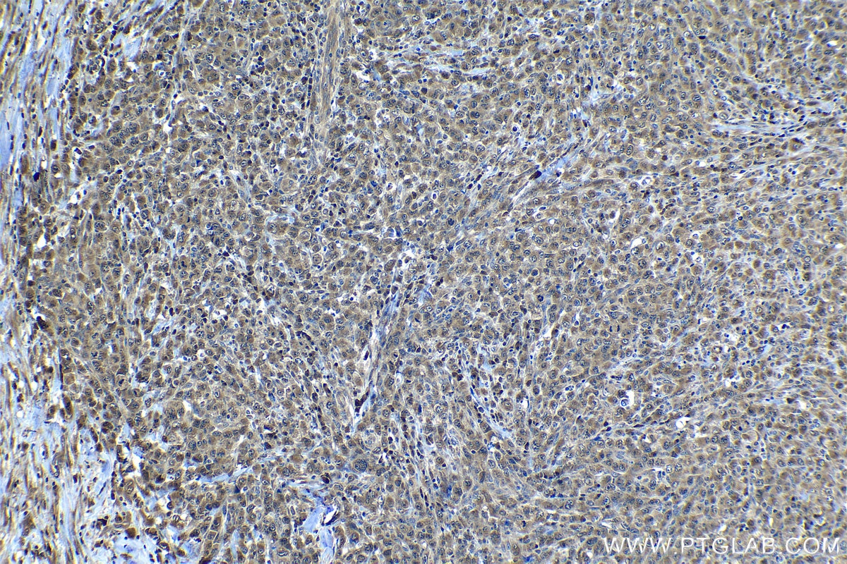 Immunohistochemical analysis of paraffin-embedded human lymphoma tissue slide using KHC1316 (PTPN2 IHC Kit).