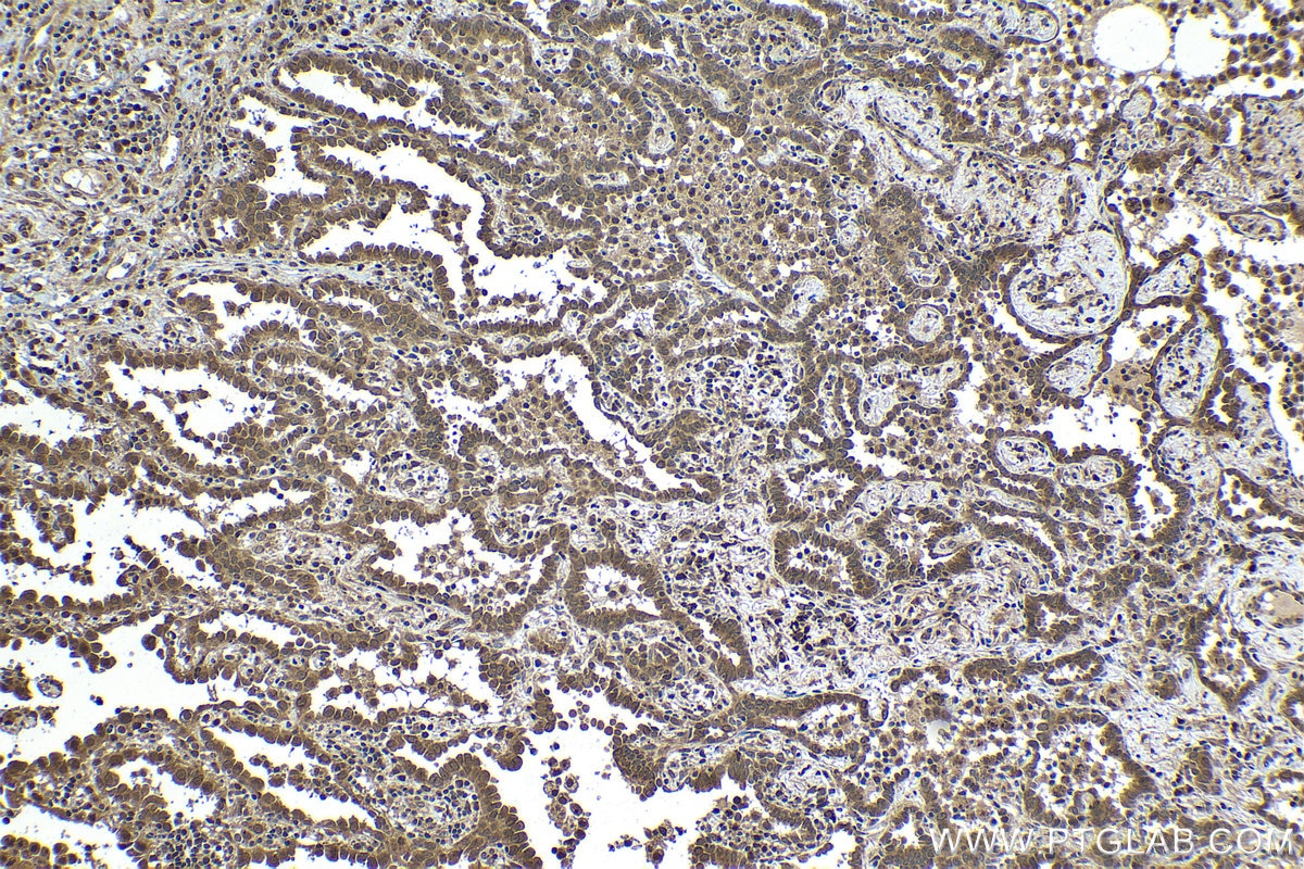 Immunohistochemical analysis of paraffin-embedded human lung cancer tissue slide using KHC1316 (PTPN2 IHC Kit).