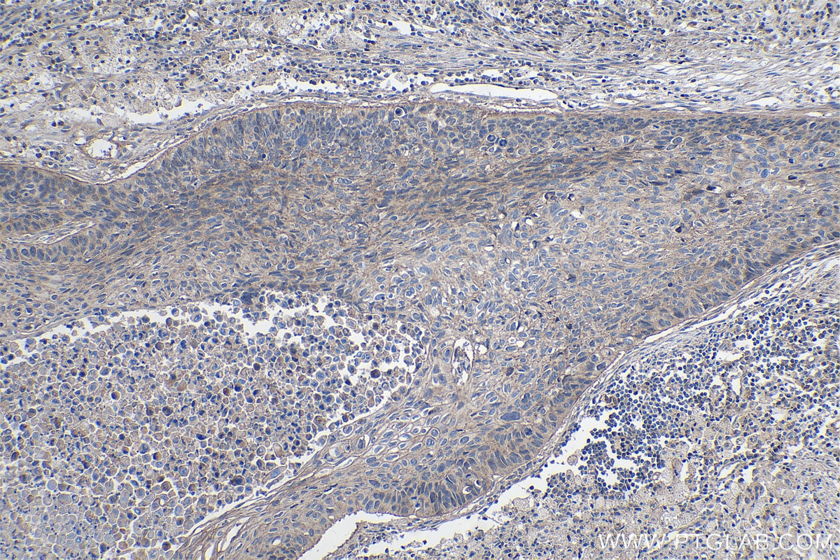 Immunohistochemical analysis of paraffin-embedded human lung cancer tissue slide using KHC1073 (PTPRA IHC Kit).