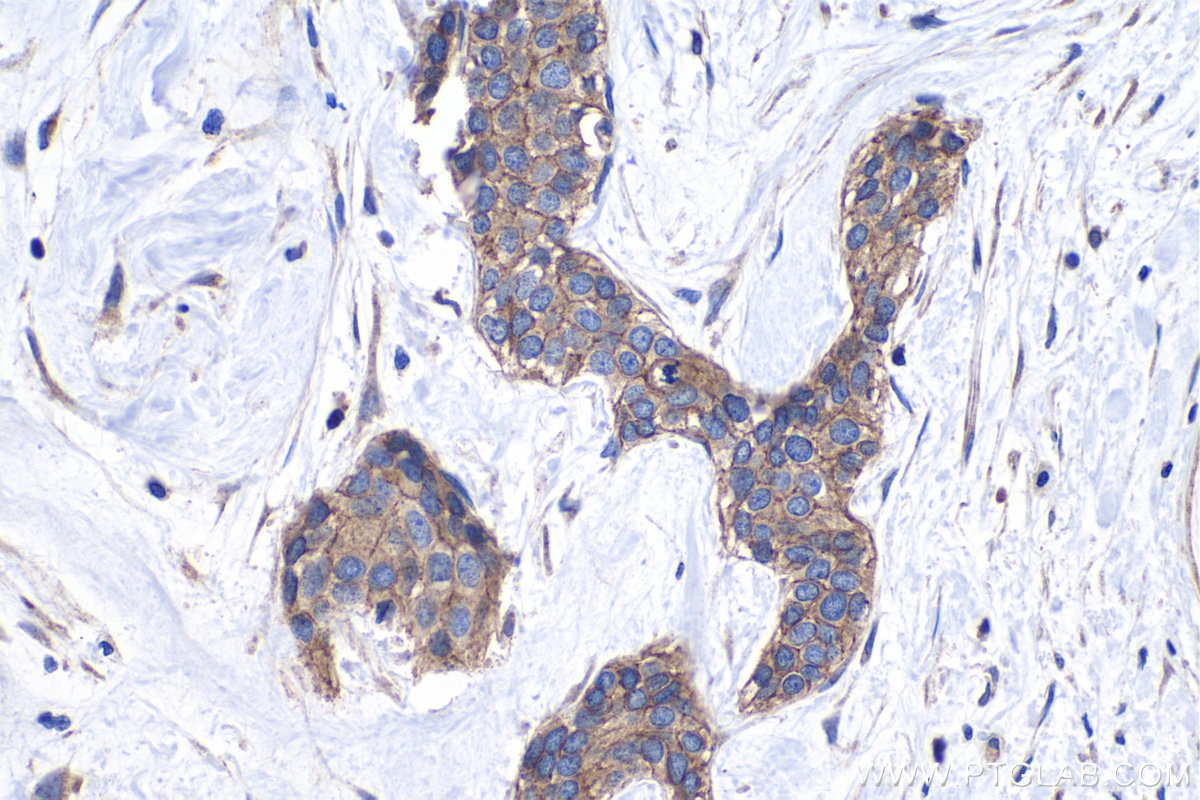 Immunohistochemical analysis of paraffin-embedded human urothelial carcinoma tissue slide using KHC1073 (PTPRA IHC Kit).