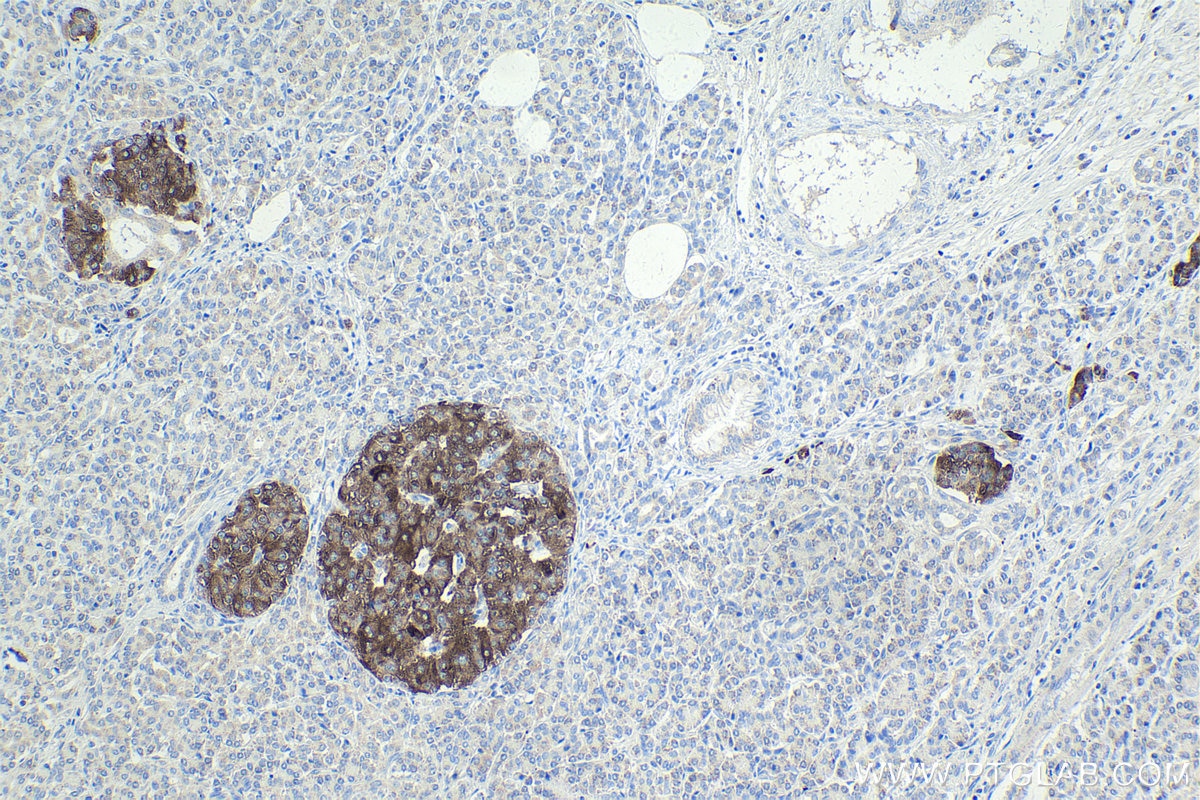 Immunohistochemical analysis of paraffin-embedded human pancreas cancer tissue slide using KHC1765 (PTPRN IHC Kit).