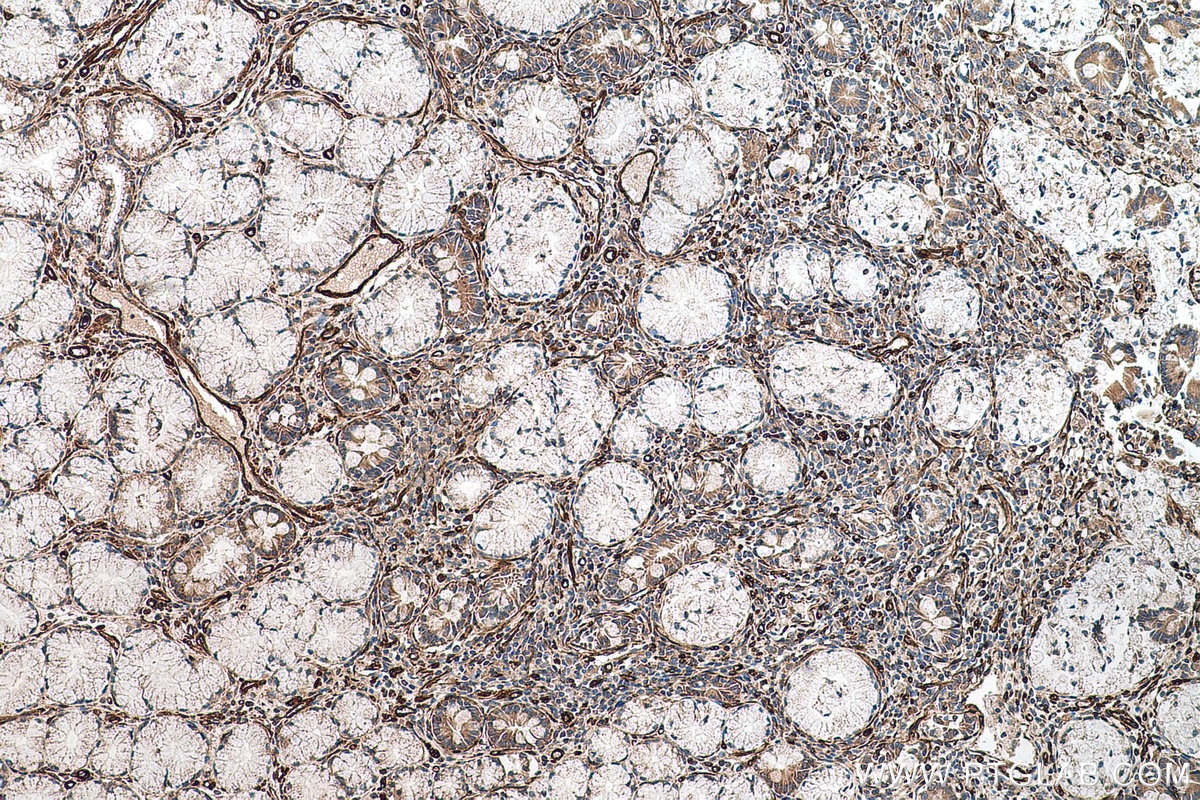 Immunohistochemical analysis of paraffin-embedded human stomach cancer tissue slide using KHC0677 (PTRF IHC Kit).