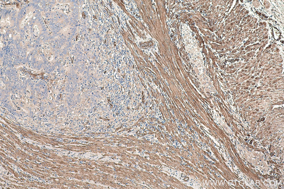 Immunohistochemical analysis of paraffin-embedded human colon cancer tissue slide using KHC0677 (PTRF IHC Kit).