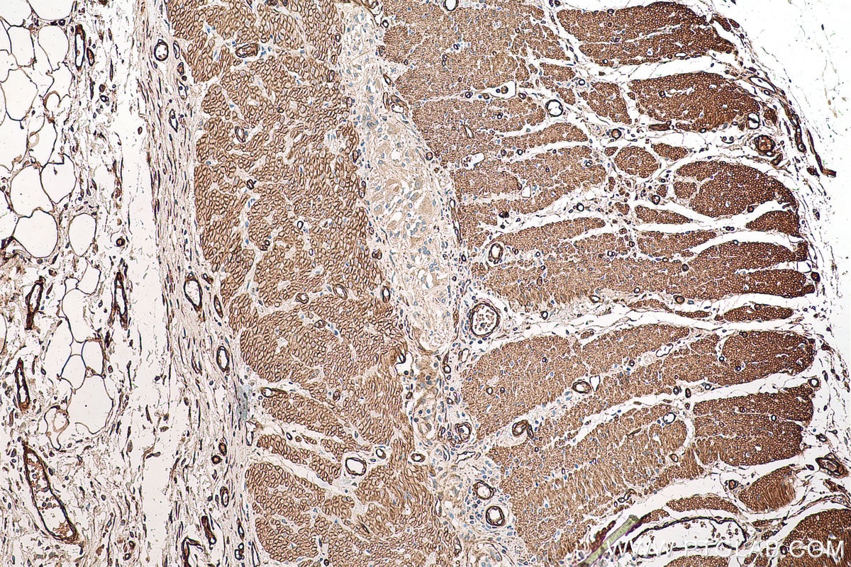 Immunohistochemical analysis of paraffin-embedded human pancreas cancer tissue slide using KHC0677 (PTRF IHC Kit).