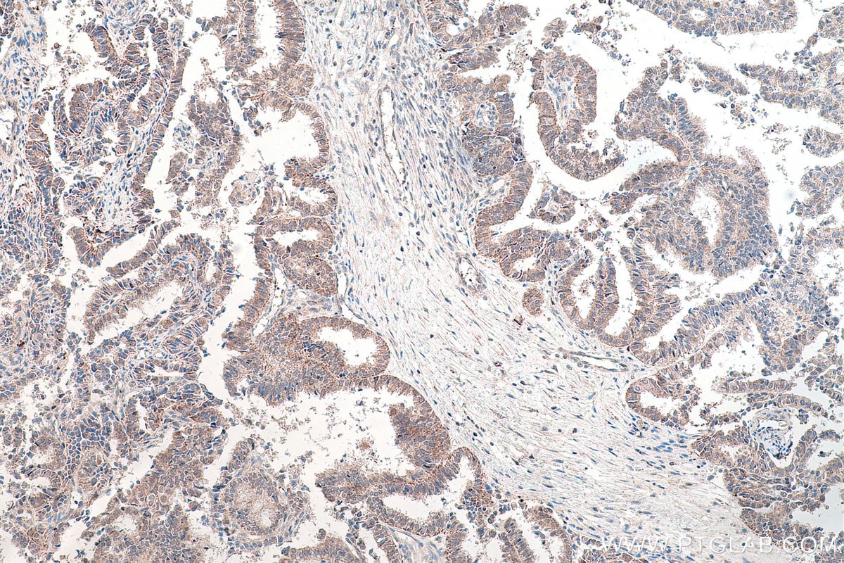 Immunohistochemical analysis of paraffin-embedded human ovary tumor tissue slide using KHC0184 (PUS1 IHC Kit).