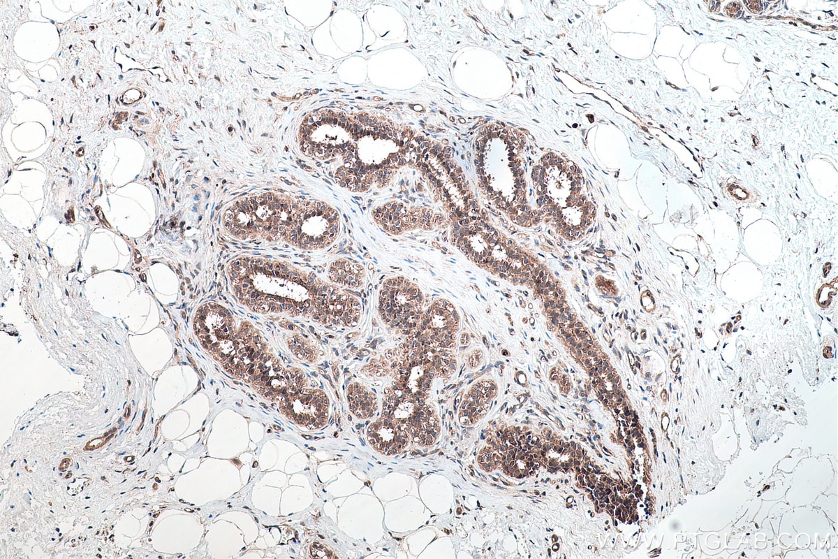 Immunohistochemical analysis of paraffin-embedded human breast cancer tissue slide using KHC0184 (PUS1 IHC Kit).