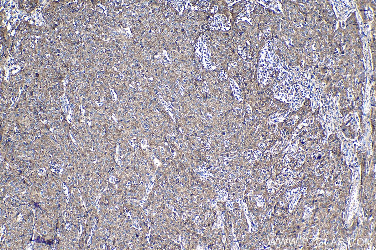 Immunohistochemical analysis of paraffin-embedded human cervical cancer tissue slide using KHC1239 (PVR IHC Kit).