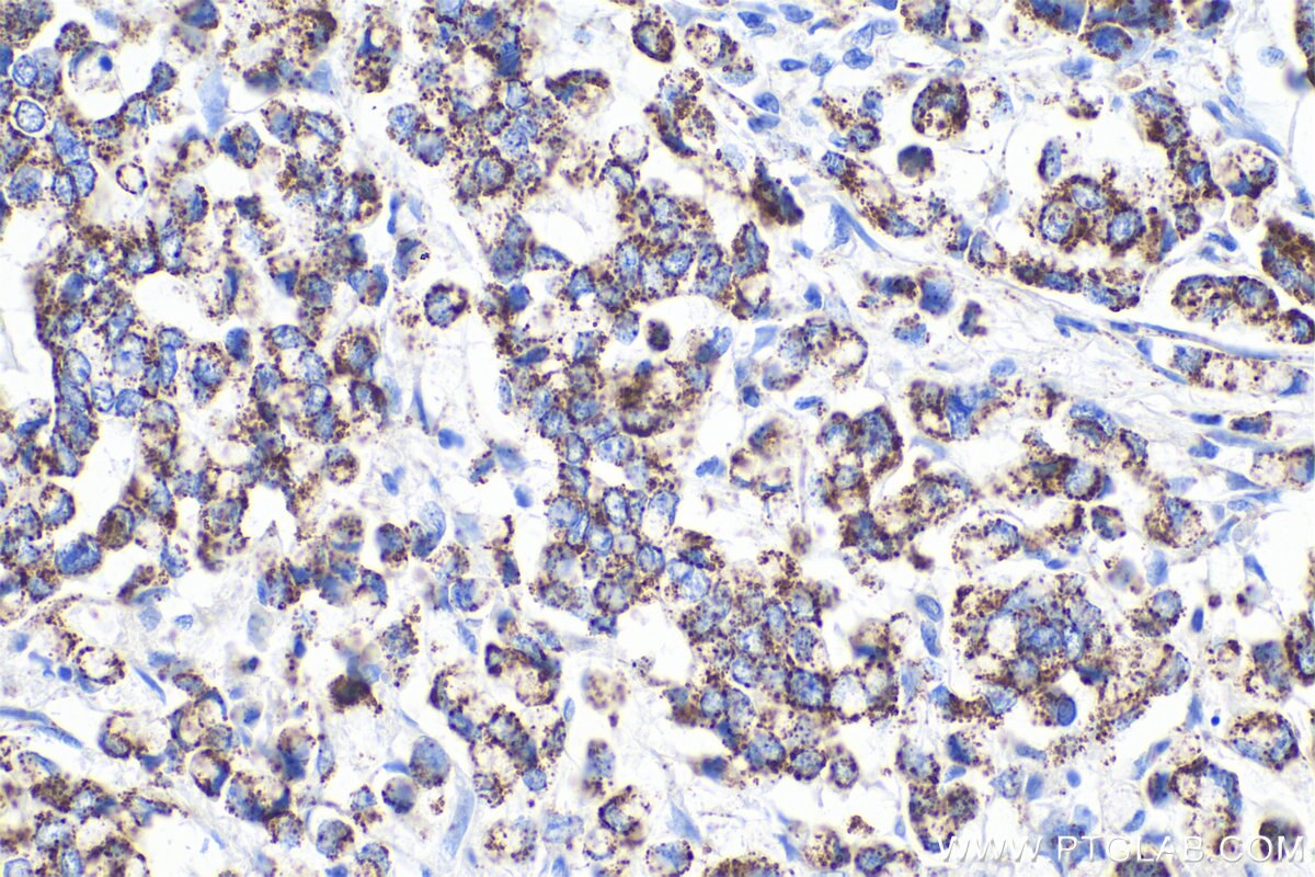 Immunohistochemical analysis of paraffin-embedded human colon cancer tissue slide using KHC0833 (PYCR1 IHC Kit).