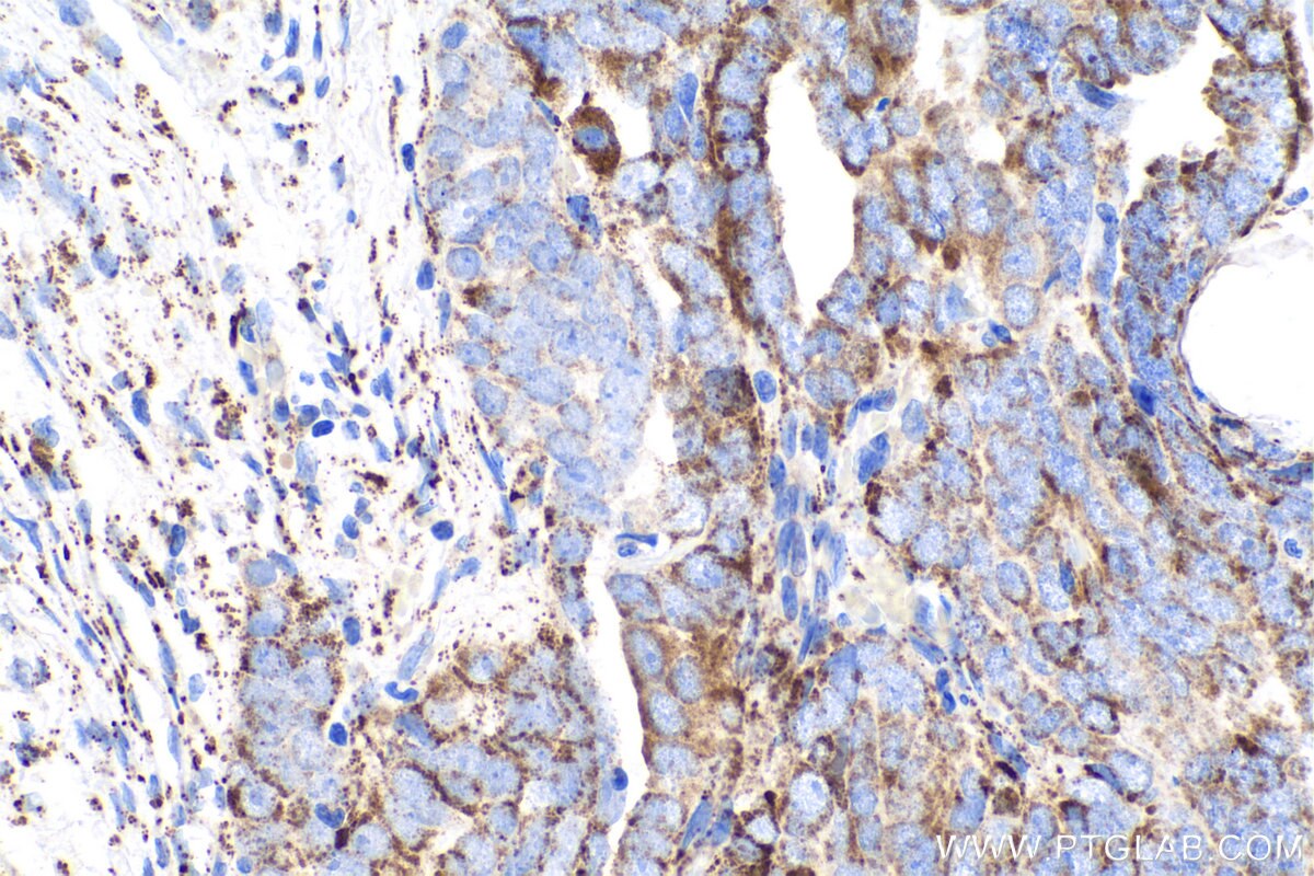 Immunohistochemical analysis of paraffin-embedded human ovary tumor tissue slide using KHC0833 (PYCR1 IHC Kit).