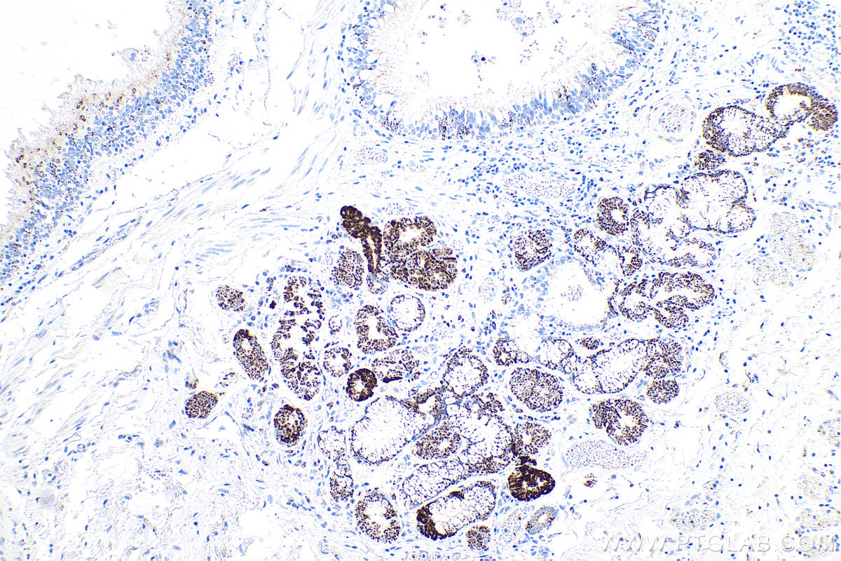 Immunohistochemical analysis of paraffin-embedded human lung cancer tissue slide using KHC0833 (PYCR1 IHC Kit).