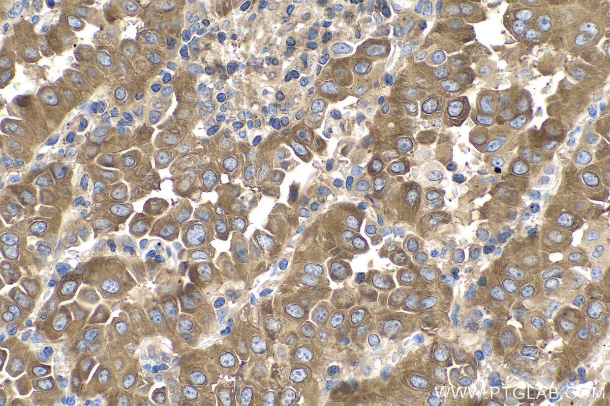 Immunohistochemical analysis of paraffin-embedded human lung cancer tissue slide using KHC0970 (PYGB IHC Kit).