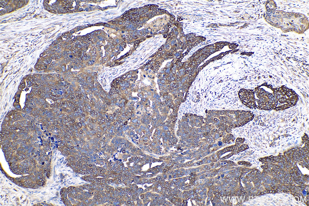 Immunohistochemical analysis of paraffin-embedded human ovary tumor tissue slide using KHC0970 (PYGB IHC Kit).