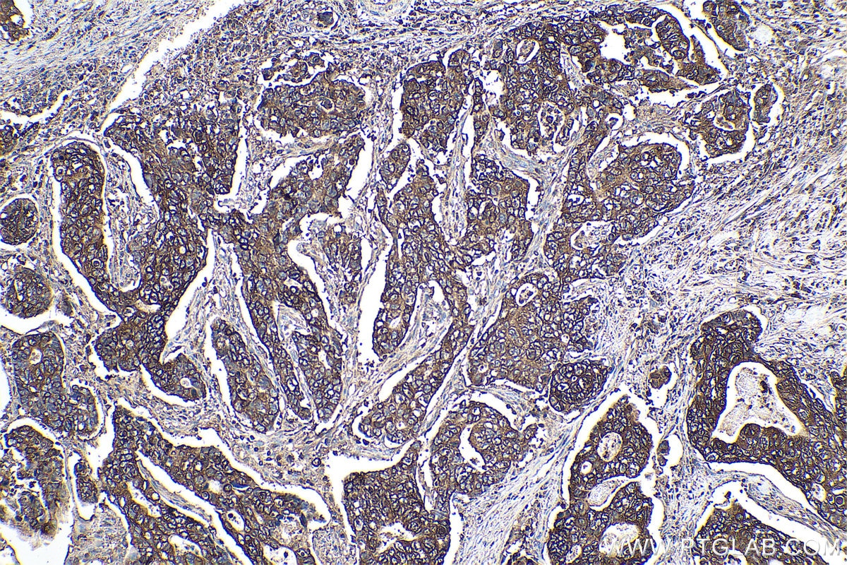 Immunohistochemical analysis of paraffin-embedded human stomach cancer tissue slide using KHC0970 (PYGB IHC Kit).