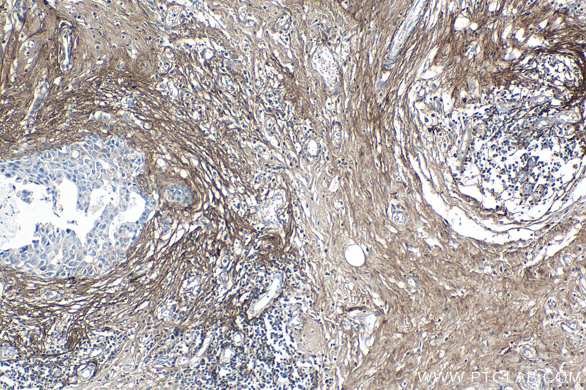 Immunohistochemical analysis of paraffin-embedded human breast cancer tissue slide using KHC0130 (Periostin IHC Kit).