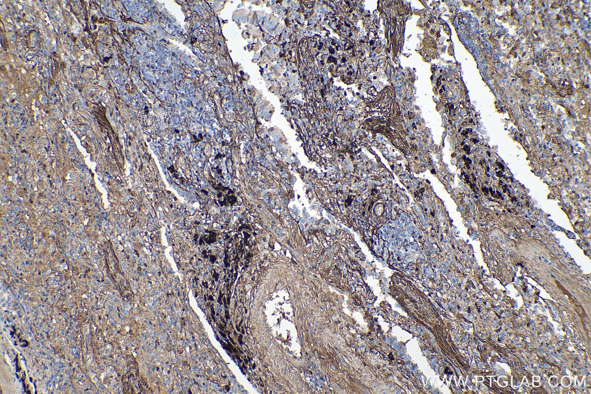 Immunohistochemical analysis of paraffin-embedded human lung cancer tissue slide using KHC0130 (Periostin IHC Kit).