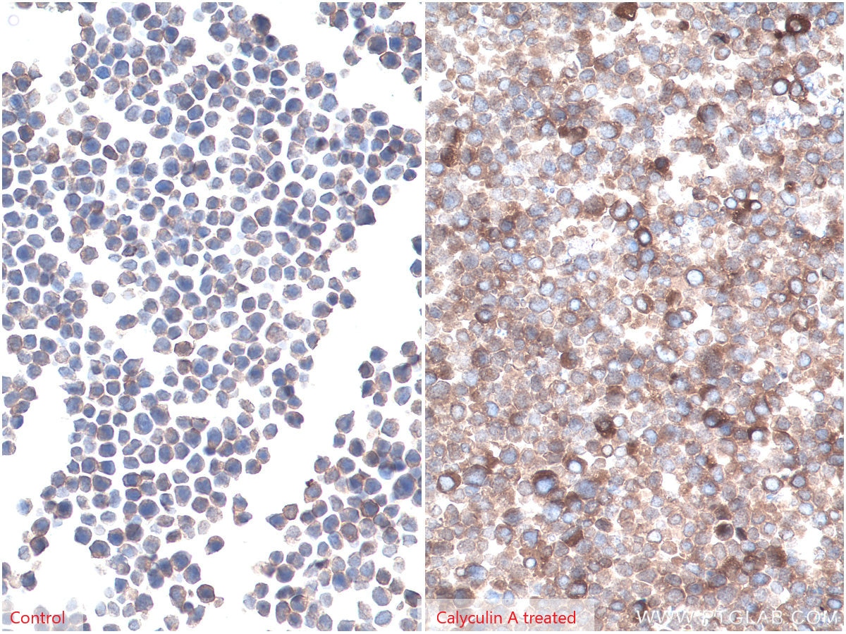 Immunohistochemical analysis of paraffin-embedded Jurkat (left) and calyculin A treated Jurkat (right) cells slide using KHC0293 (Phospho-AKT (Ser473) IHC Kit).