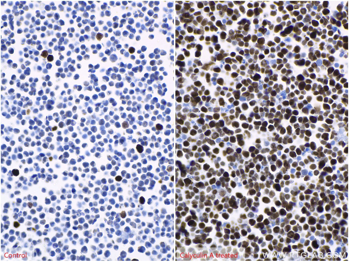 Immunohistochemical analysis of paraffin-embedded Jurkat (left) and calyculin A treated Jurkat (right) cells slide using KHC1439 (Phospho-Histone H3 (Ser10) IHC Kit).