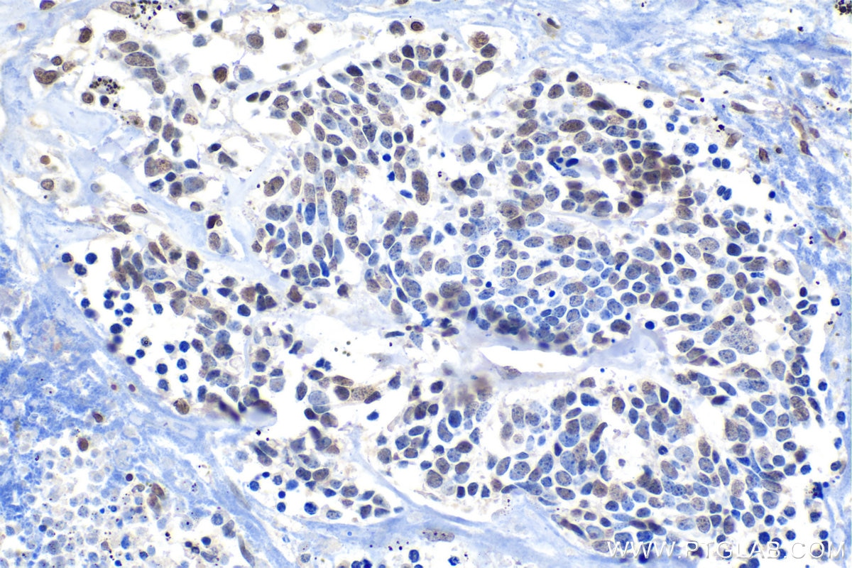 Immunohistochemical analysis of paraffin-embedded human lung cancer tissue slide using KHC1439 (Phospho-Histone H3 (Ser10) IHC Kit).