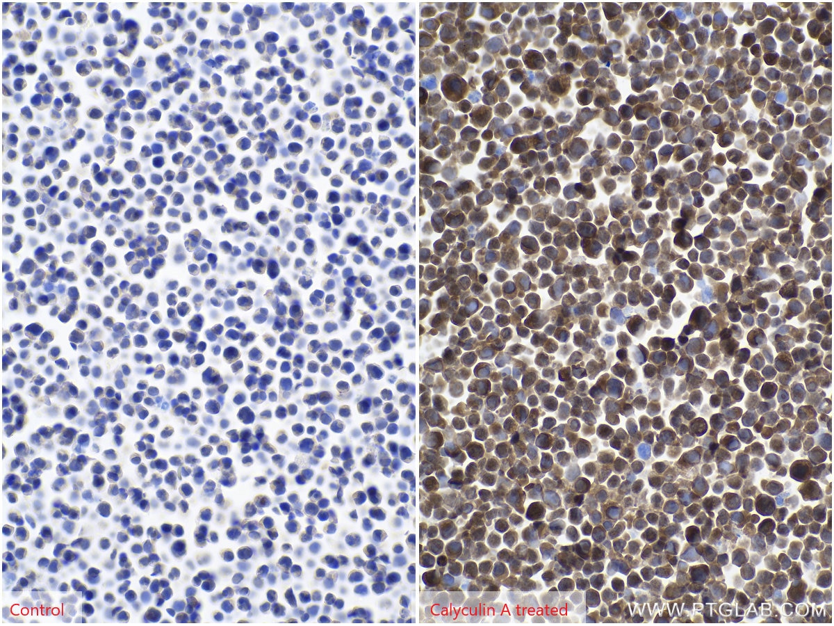 Immunohistochemical analysis of paraffin-embedded Jurkat (left) and calyculin A treated Jurkat (right) cells slide using KHC0291 (Phospho-TDP43 (Ser409/410) IHC Kit).