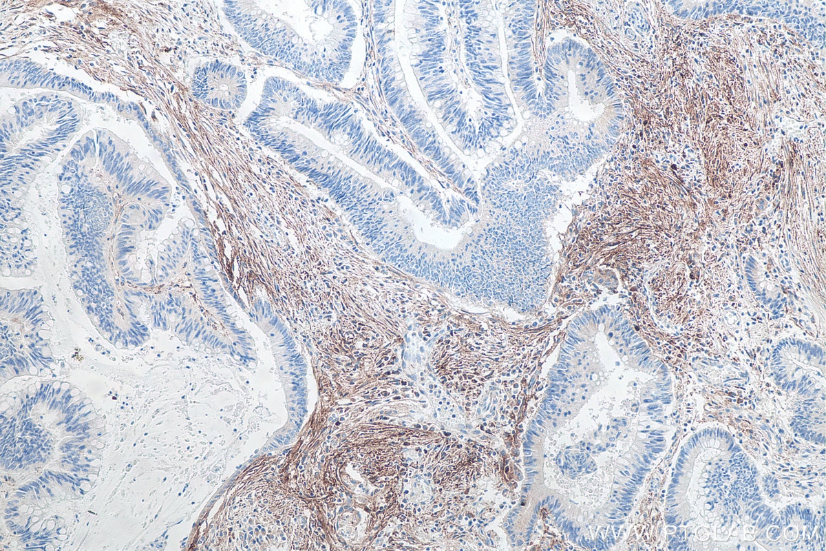 Immunohistochemical analysis of paraffin-embedded human colon cancer tissue slide using KHC0092 (Podoplanin IHC Kit).