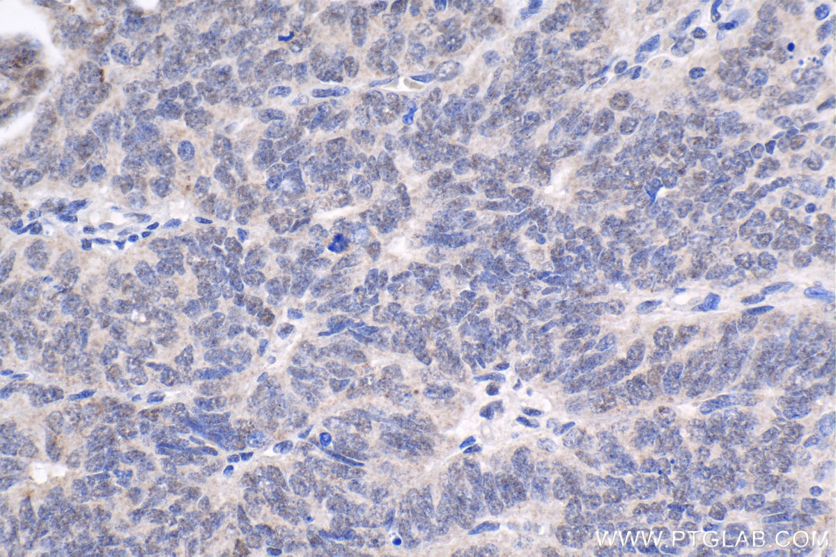 Immunohistochemical analysis of paraffin-embedded human ovary tumor tissue slide using KHC1767 (QRICH1 IHC Kit).