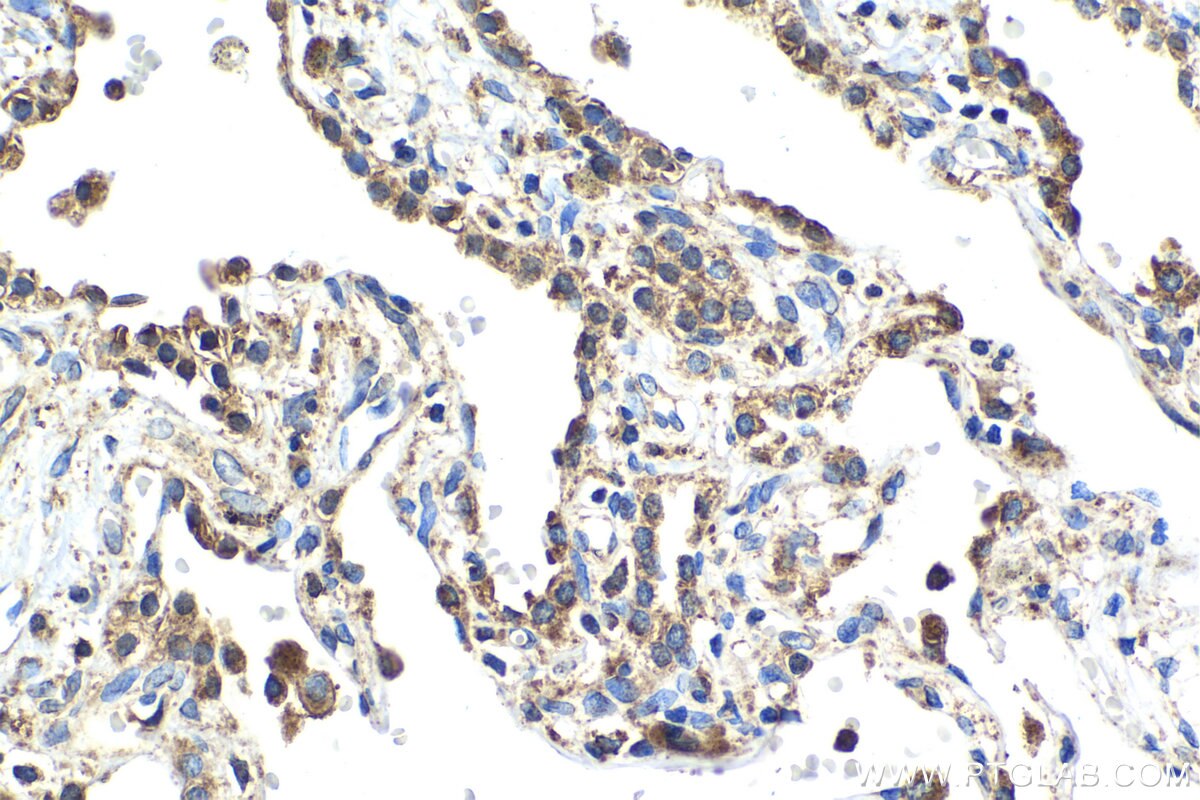 Immunohistochemical analysis of paraffin-embedded human lung tissue slide using KHC2043 (QSOX1 IHC Kit).