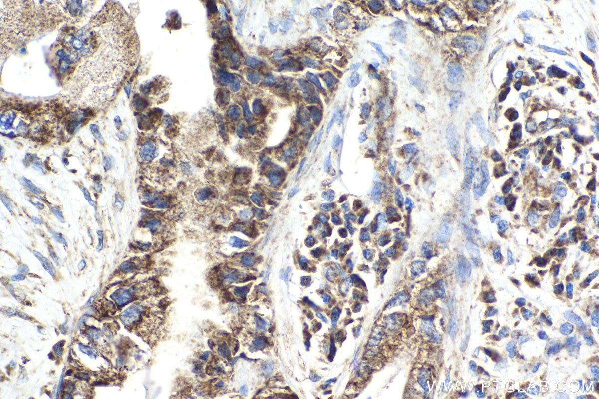 Immunohistochemical analysis of paraffin-embedded human pancreas cancer tissue slide using KHC2043 (QSOX1 IHC Kit).