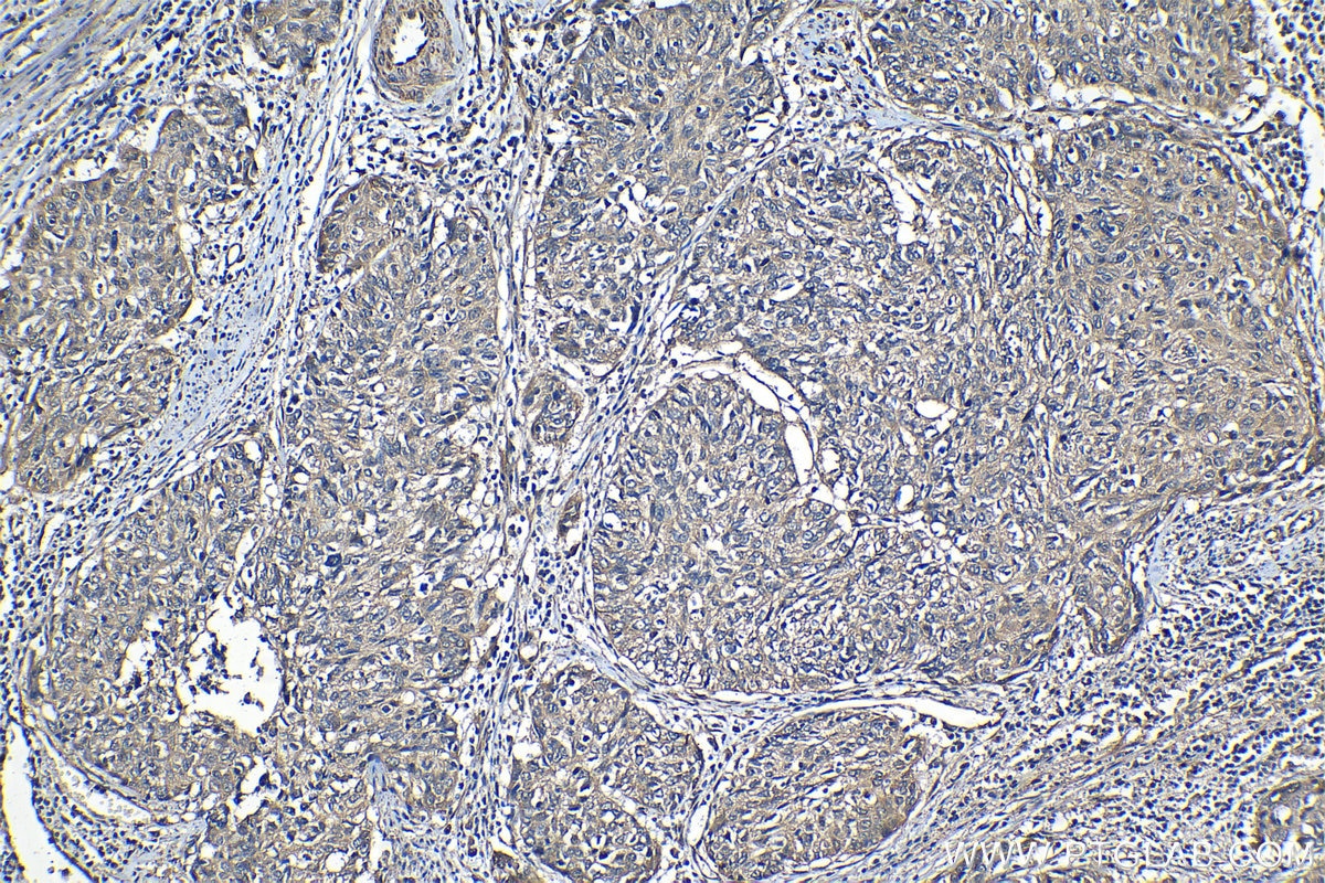 Immunohistochemical analysis of paraffin-embedded human cervical cancer tissue slide using KHC1276 (RAB11FIP5 IHC Kit).